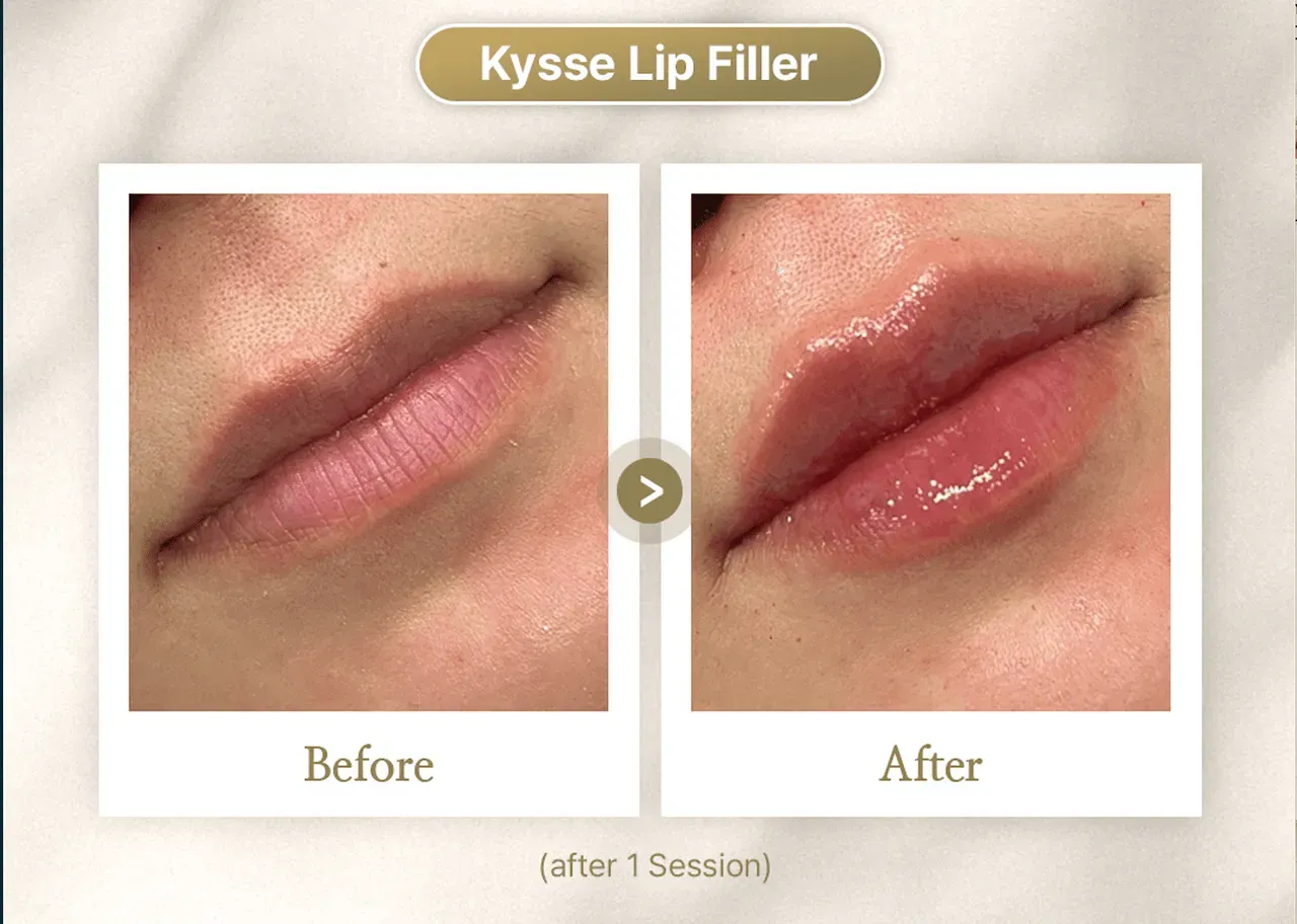 Dermal Filler / Lip Augmentation