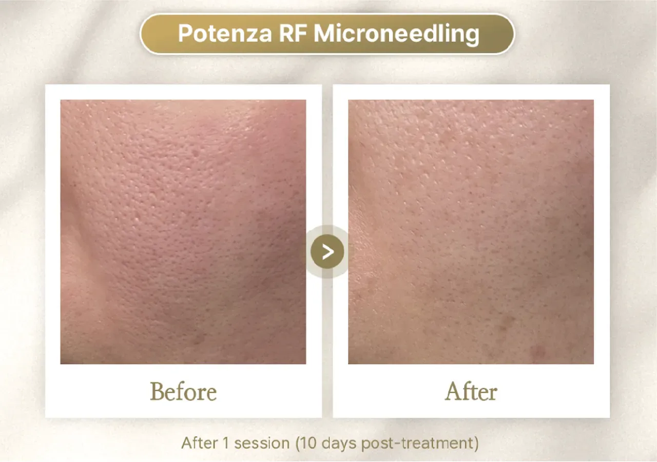 RF Microneedling