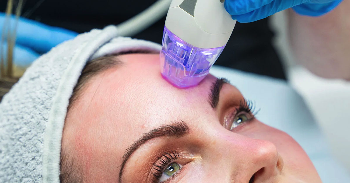 Potenza-RF-microneedling-بوتنزا